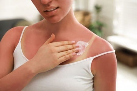 Sončne opekline: Kako se zaščititi in kako ozdraviti opečeno kožo s Cicatridino?